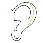Earlobes  correction