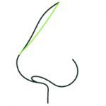 Rhinoplasty