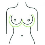 Augmentation with implants