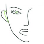 Auriculoplasty